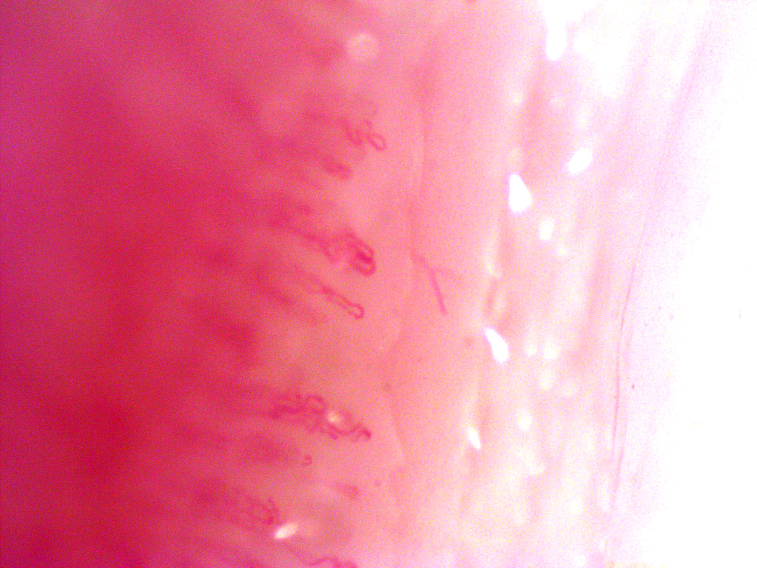 Nailfold capillaries as seen thru ZEISS Skin Microscope